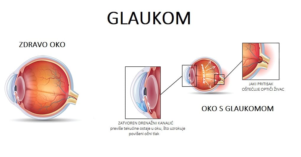 šta je glaukom i da li se može pojaviti kod mladih?